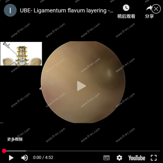 UBE- Ligamentum flavum layering -Corner area enters the spinal canal to operate AYDEFY