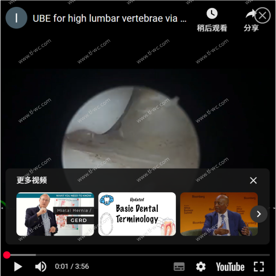 UBE for high lumbar vertebrae via pedicle approach: Everything for thornness